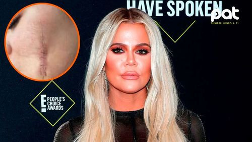 Khloé Kardashian revela las secuelas de su cirugía por cáncer de piel