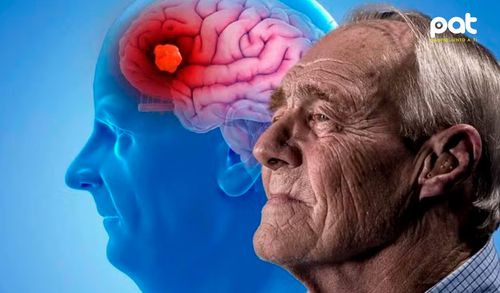 Descubrimiento genético prometedor para el tratamiento del Alzheimer