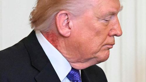 ¿Qué tiene Donald Trump en el  cuello? Médico atribuye sarpullido  a tratamiento preventivo
